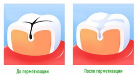 Герметизация  фиссур