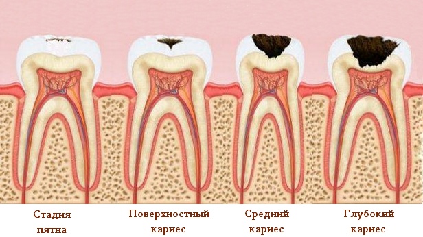 Глубокий кариес