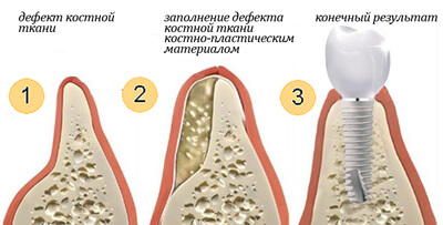 Остеопластика