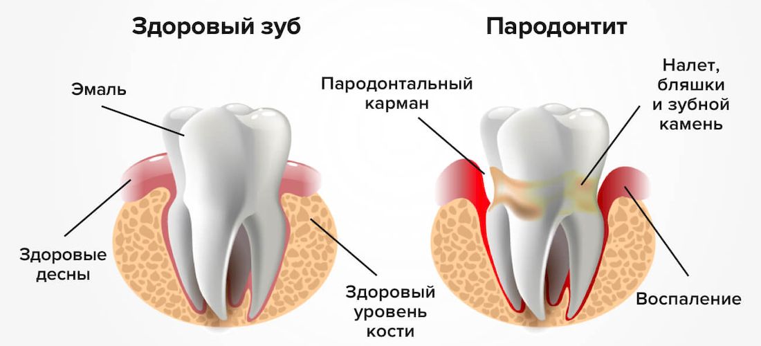 Лечение и возникновение пародонтита