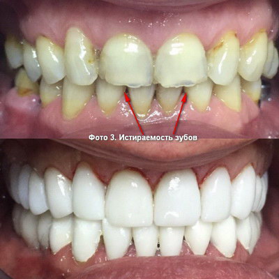 color stom 3