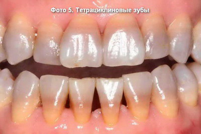 color stom 5