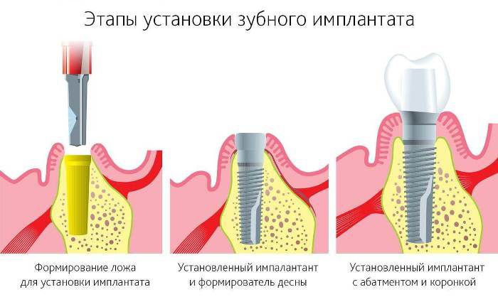 Этапы установки эмплантов