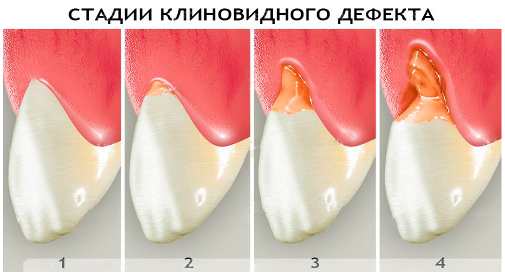 Клиновидный дефект зубов